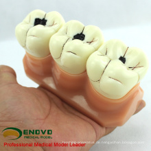 Verkaufen 12575 Karies Demonstration Zähne Modell für zahnmedizinische Lehre Kommunikation
